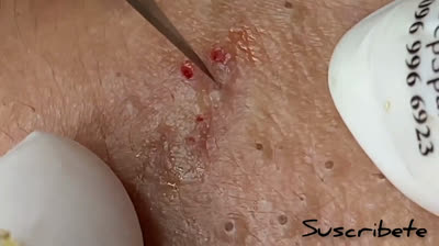 Observa cómo una enorme espinilla es extraída en este video que te mantendrá completamente cautivado.