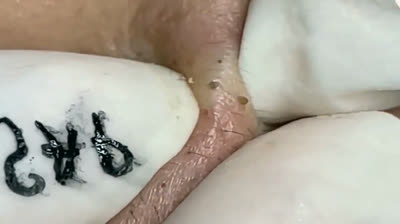 Descubre el video que está causando sensación en las redes sociales, mostrando la satisfacción de eliminar espinillas. 