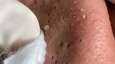 Descubre por qué este video viral de espinillas sorprendentes está generando tantos comentarios y conversaciones en todo el mundo. 