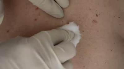 Prepárate para asombrarte con esta increíble extracción de espinilla que te dejará boquiabierto.