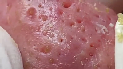 Experimenta una satisfacción instantánea al ver este video viral de espinillas que brinda una satisfacción definitiva.