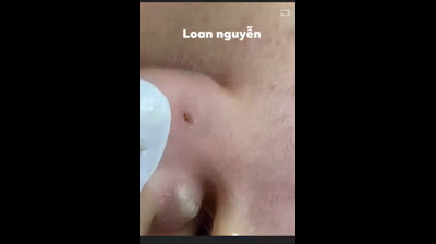 Prepárate para quedarte sin palabras al ver cómo desaparecen las espinillas en este video viral que muestra transformaciones increíbles.